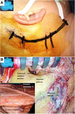 Feasibility of an endoscope-dominated side-to-end hypoglossal-facial anastomosis: an anatomical study